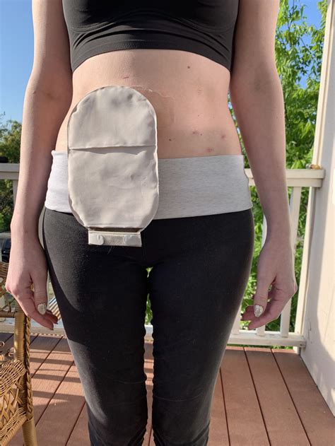 stoma travel bag|flying with an ileostomy bag.